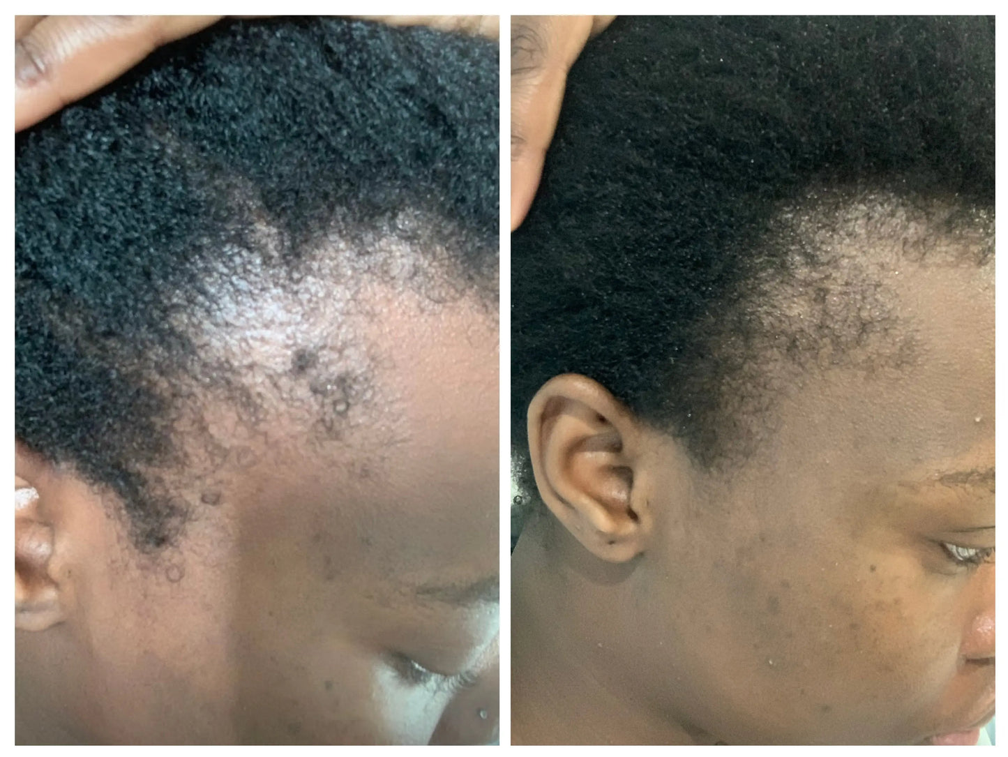 Before and after showing fuller edges after consistent use of KEMDII Blüom Hair & Scalp Oil with rosemary extract
