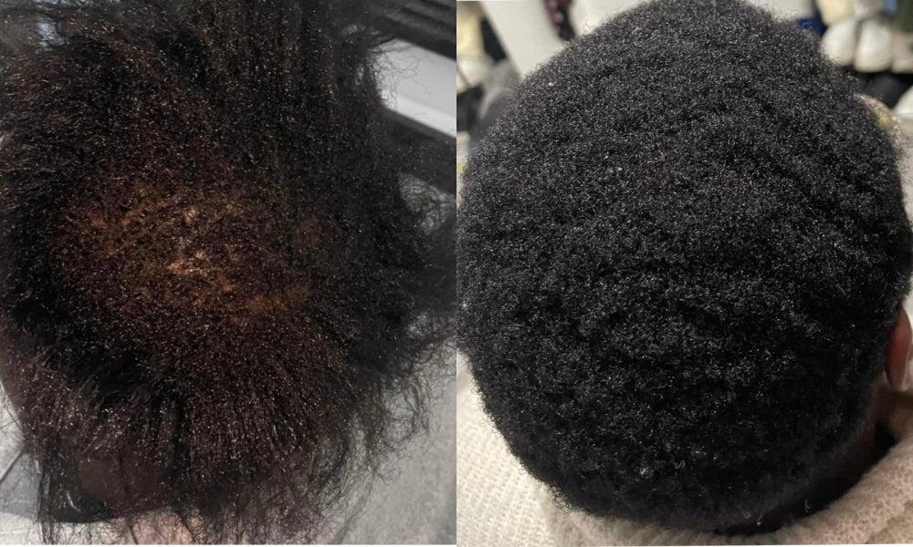 Before and after comparison of a a person with alopecia with visible hair growth results using KEMDII 